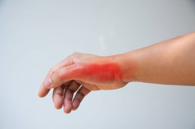 Romatoid eklem iltihabının acı dolu kırmızı hücresi.