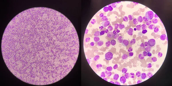 Esfregaço Sangue Anormal Esquerdo 10X Microscópio Esfregaço Sangue Anormal Direito — Fotografia de Stock