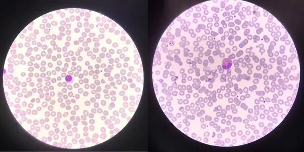 Левый Лимфоцит Правый Эозинофил Белые Клетки Крови Найти Микроскопом — стоковое фото