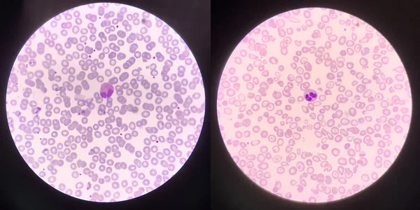 Eosinófilo Izquierdo Glóbulos Blancos Neutrófilos Derechos Encuentre Con Microscopio —  Fotos de Stock