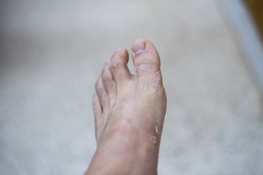 Pateint deri dermatiti ayağını kapat..