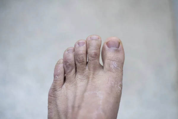 Затискання Ноги Паштетового Дерматиту Шкіри — стокове фото