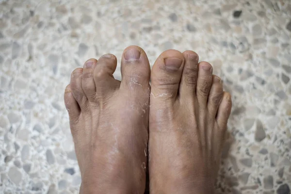 特許取得済みの皮膚炎の足をクロックス — ストック写真