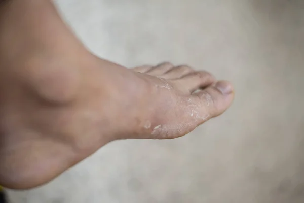 Cloxe Para Cima Dermatite Cutânea Pateint — Fotografia de Stock