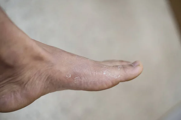 Cloxe Foot Pateint Skin Dermatitis — Stock Photo, Image