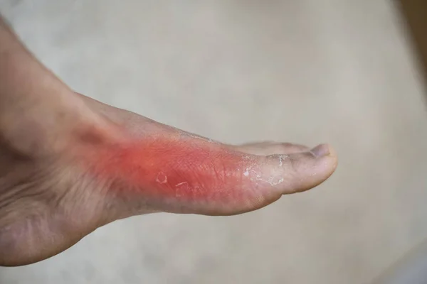 足を閉じる 皮膚関節炎の治療 — ストック写真