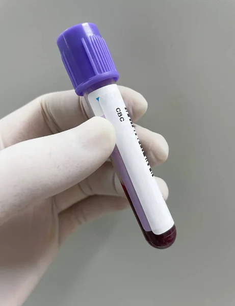 Tube Essai Edta Test Cbc Anticoagulant Échantillon Sang — Photo