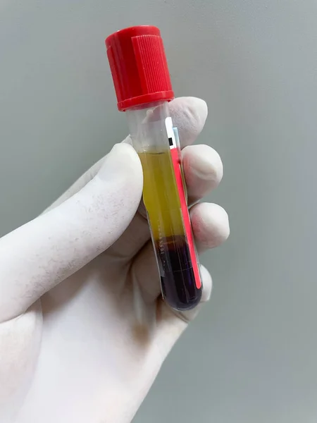 Tubo Ensayo Rojo Sin Sangre Coagulada Anticoagulante Muestra Sangre — Foto de Stock