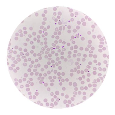 Kan lekeli kırmızı kan hücresi. Hematoloji..