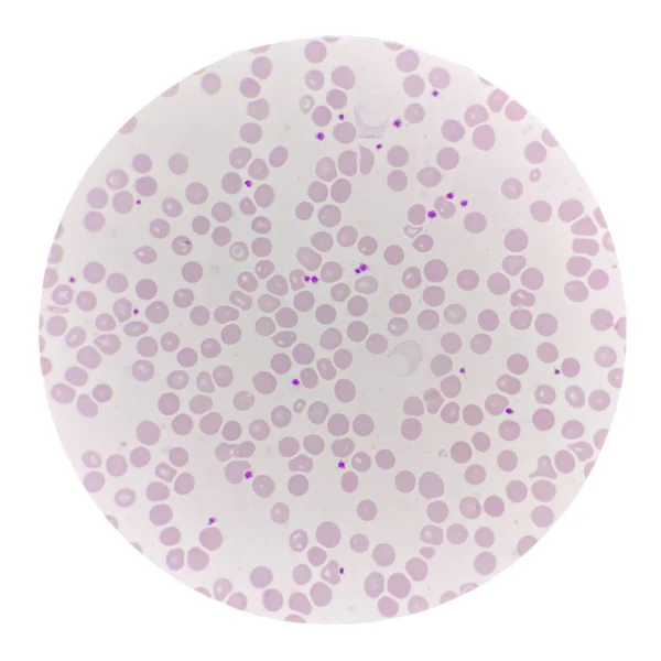 Rode Bloedcel Met Bloedplaatjes Bloeduitstrijk Hematologie — Stockfoto