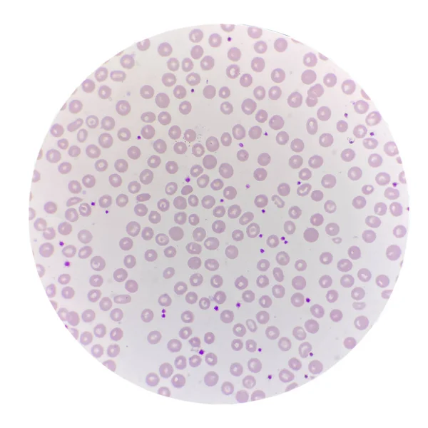 血涂片中的血小板红血球 血液学 — 图库照片