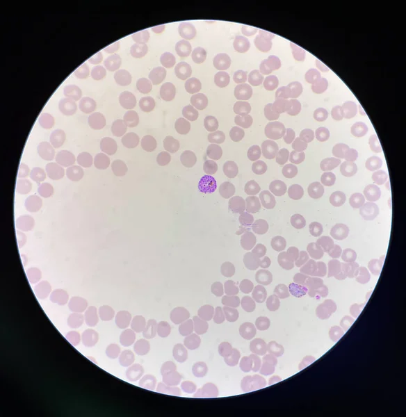 Malaria Parásito Sanguíneo Infectado Glóbulos Rojos Antecedentes Laboratorio — Foto de Stock