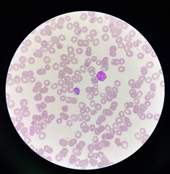 Sıtma Kan Paraziti Alyuvar Hücrelerinin Laboratuvar Geçmişini Etkilemiş — Stok fotoğraf