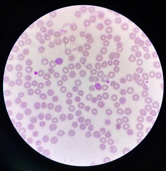 Malaria Blood Parasite Infected Red Blood Cells Laboratory Background — ストック写真