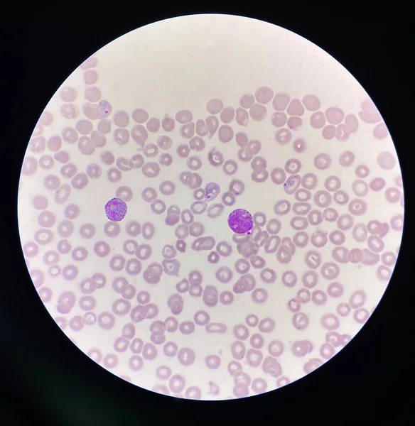 マラリア原虫感染赤血球研究室の背景 — ストック写真
