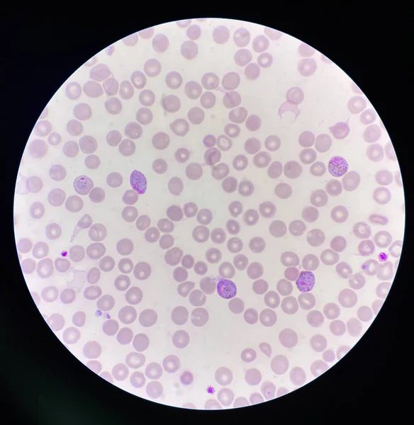 Malaria Blood Parasite Infected Red Blood Cells Laboratory Background — ストック写真