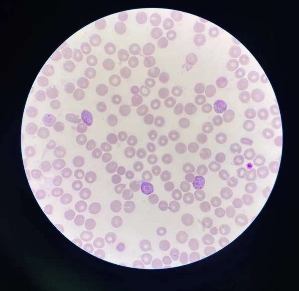 Malaria Blod Parasit Infekterade Röda Blodkroppar Laboratorium Bakgrund — Stockfoto