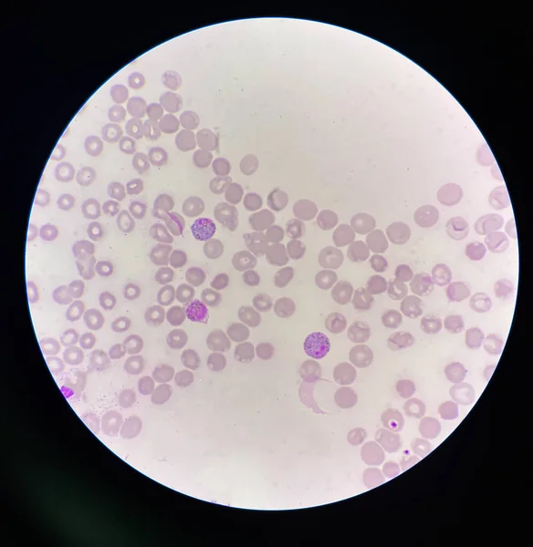 Malaria Parásito Sanguíneo Infectado Glóbulos Rojos Antecedentes Laboratorio —  Fotos de Stock