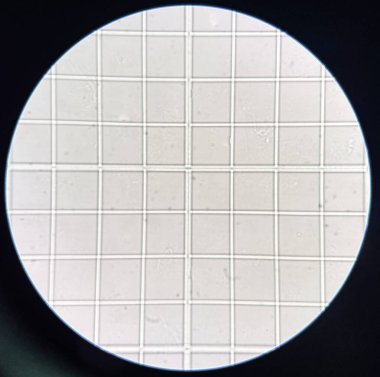 Laboratuvarda mikroskop ile ölçülen idrar tortusu.