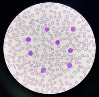 white blood cell  lymphocyte on red blood cells background.