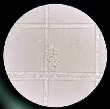 Scale with urine reader finding sediment squamous epithelial cells..