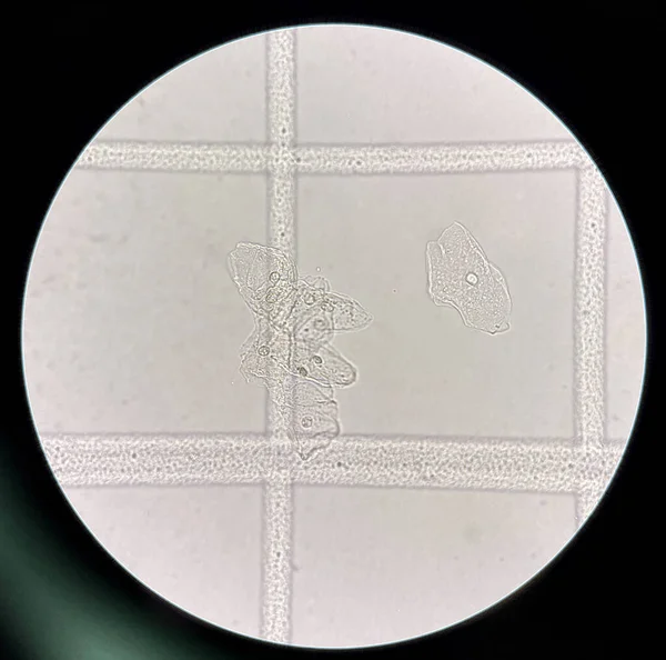 Scale with urine reader finding sediment squamous epithelial cells..