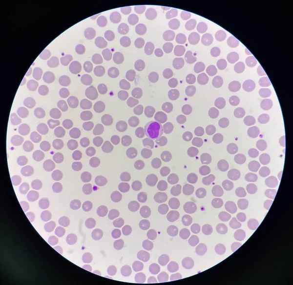 Normochromic Normocytic Rbc Blood Smear 100X Microscope — 图库照片