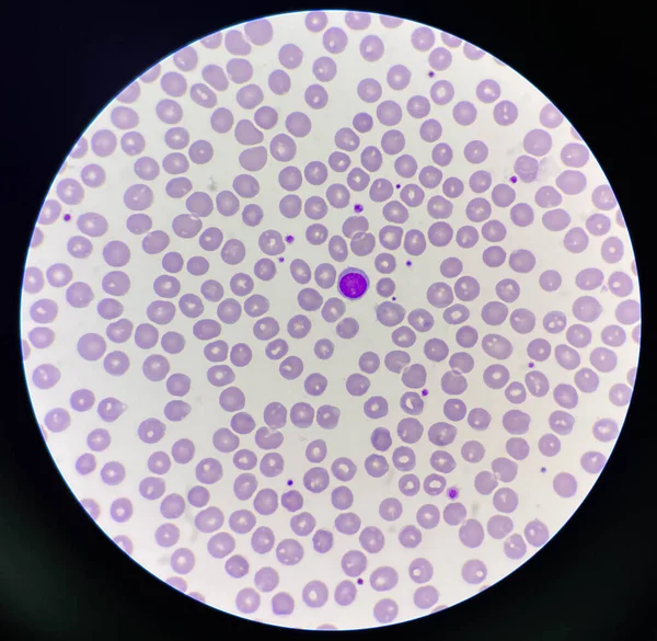 Esfregaço Sangue Normocrômico Normocítico 100X Microscópio — Fotografia de Stock