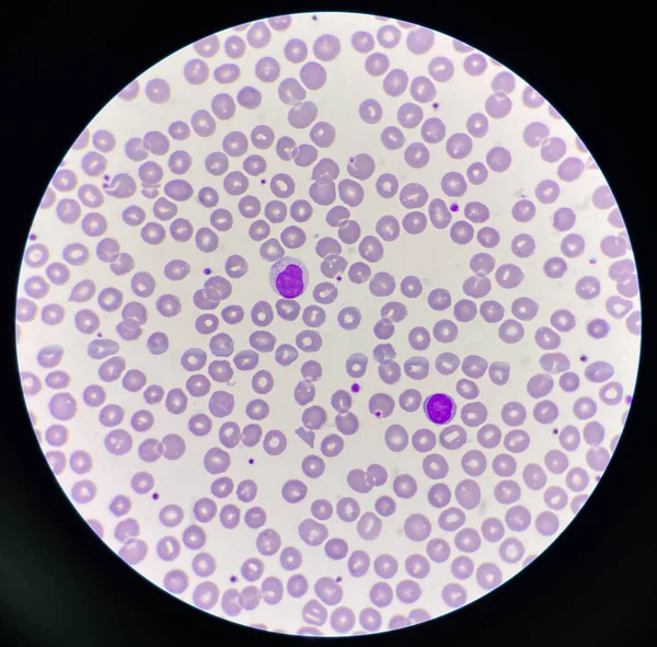 Нормохромный Нормоцитарный Rbc Мазок Крови 100X Микроскоп — стоковое фото
