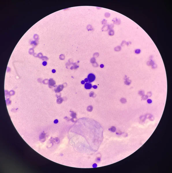 Abnormal cells wright stain in body fluid.