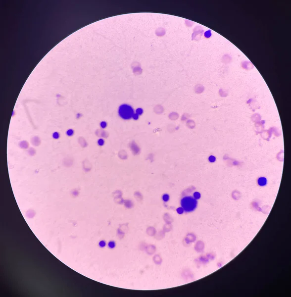 Abnormale Zellen Färben Sich Körperflüssigkeit — Stockfoto
