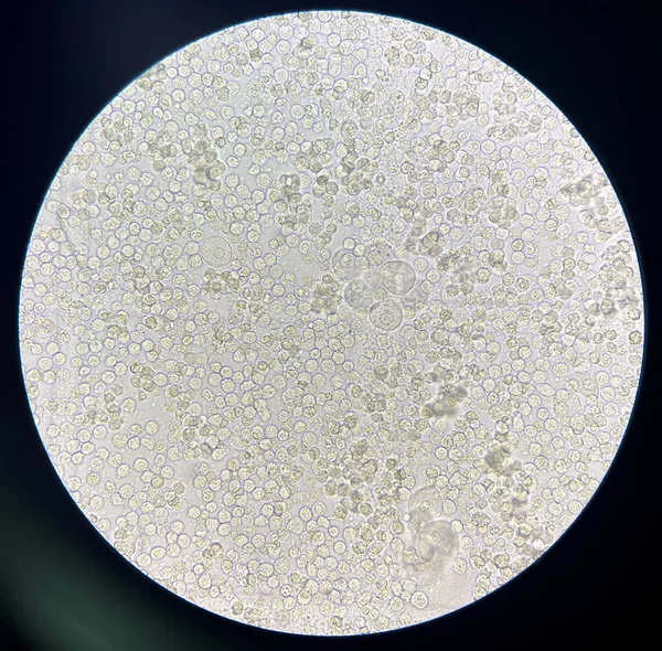 Bactérias Moderadas Glóbulos Brancos Itu Urinária — Fotografia de Stock