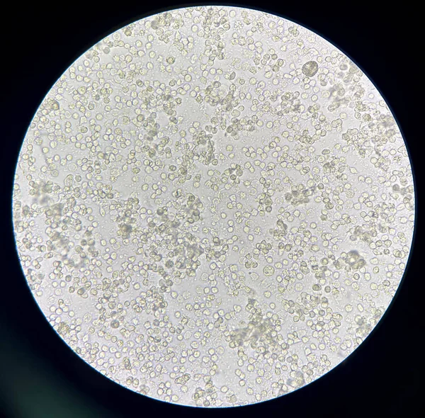 Moderate Bacteria White Blood Cells Urine Uti — Stock Photo, Image