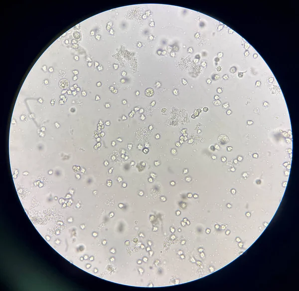 尿中の中程度の細菌と白血球 Uti ストック写真