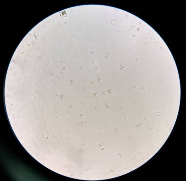 Dismorfik idrar yolları RBC 'leri küresel patolojinin bir göstergesi olarak kabul edilir ve idrar tortularında dismorfik RBC' ler