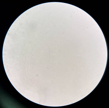 Laboratuvarda idrar tortularında taze sperm..