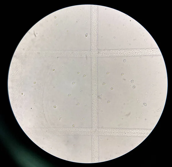 Los Glóbulos Rojos Urinarios Dismórficos Han Considerado Indicador Patología Glomerular — Foto de Stock