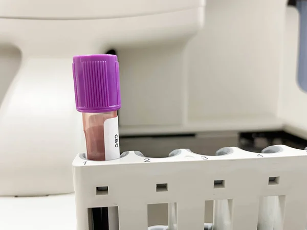 Tubo Teste Roxo Edta Sangue Conceito Laboratório Teste Cbc — Fotografia de Stock