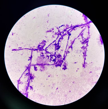 Tomurcuklanan maya hücreleri idrar örneğinde psödohyphae ile mikroskop ile 100X