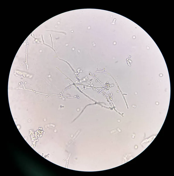 Cellules Levure Bourgeonnantes Avec Pseudohyphes Dans Urine Recherche Échantillon Microscope — Photo