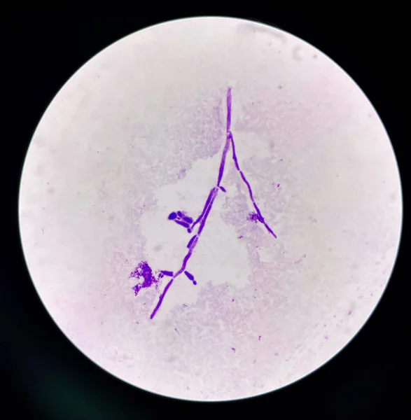 현미경으로 따르면 의사의 샘플에 진균을 세포를 첨가하는 — 스톡 사진