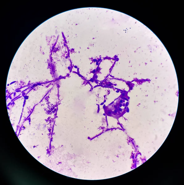 Células Levedura Brotamento Com Pseudohifas Amostra Urina Encontrando Com Microscópio — Fotografia de Stock