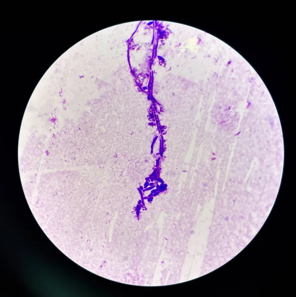 Budding yeast cells with pseudohyphae in urine sample finding with microscope 100X