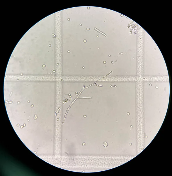 Çiş örneğinde psödohifae bulunan maya hücreleri mikroskop 40X ile bulunuyor.