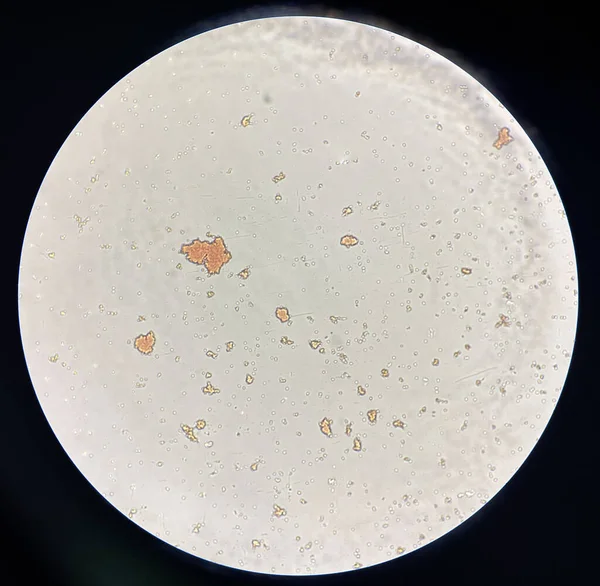 Aglutinación Glóbulos Rojos Crossmatching Donante Incompatible Laboratorio Del Banco Sangre — Foto de Stock