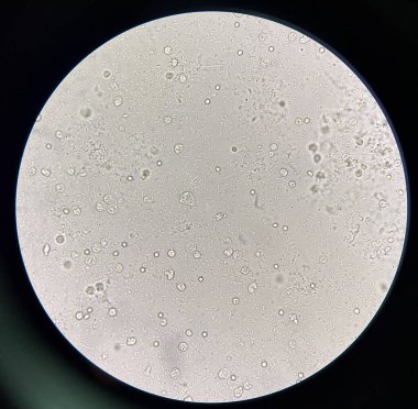 İdrar örneğinde orta derecede bakteri.