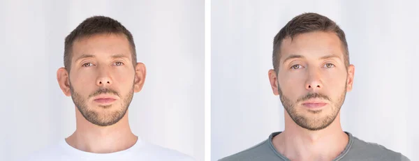 Otoplastia. Cirugía de oído. Antes y después de la operación. Concepto de cirugía plástica —  Fotos de Stock