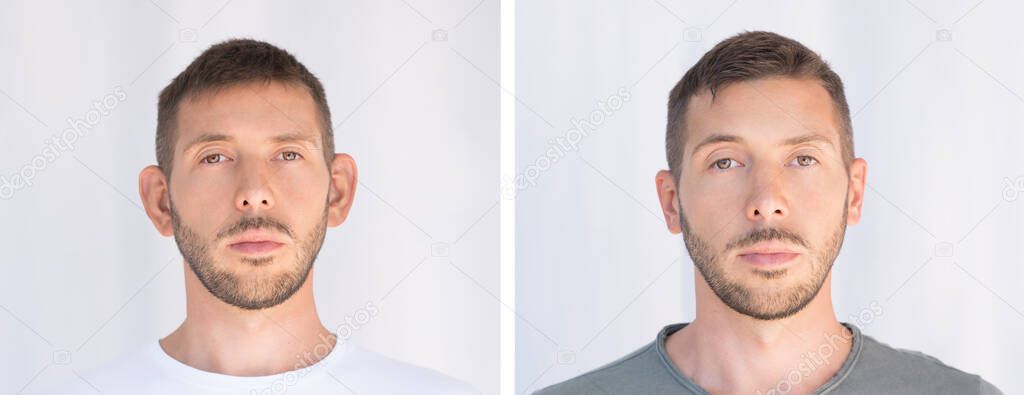Otoplasty. Ear surgery. Before and after the operation. Plastic surgery concept
