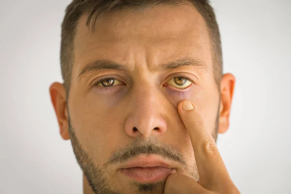 Homem doente com olhos amarelos. Doença hepática. Problemas com o fígado. Icterícia — Fotografia de Stock