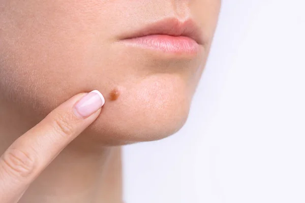 Closeup of mole on woman face. Birthmark or nevus. Copy space — Stock Photo, Image